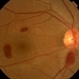 Ocular Manifestation of Acute Leukemia Ocular Manifestation of Acute Leukemia